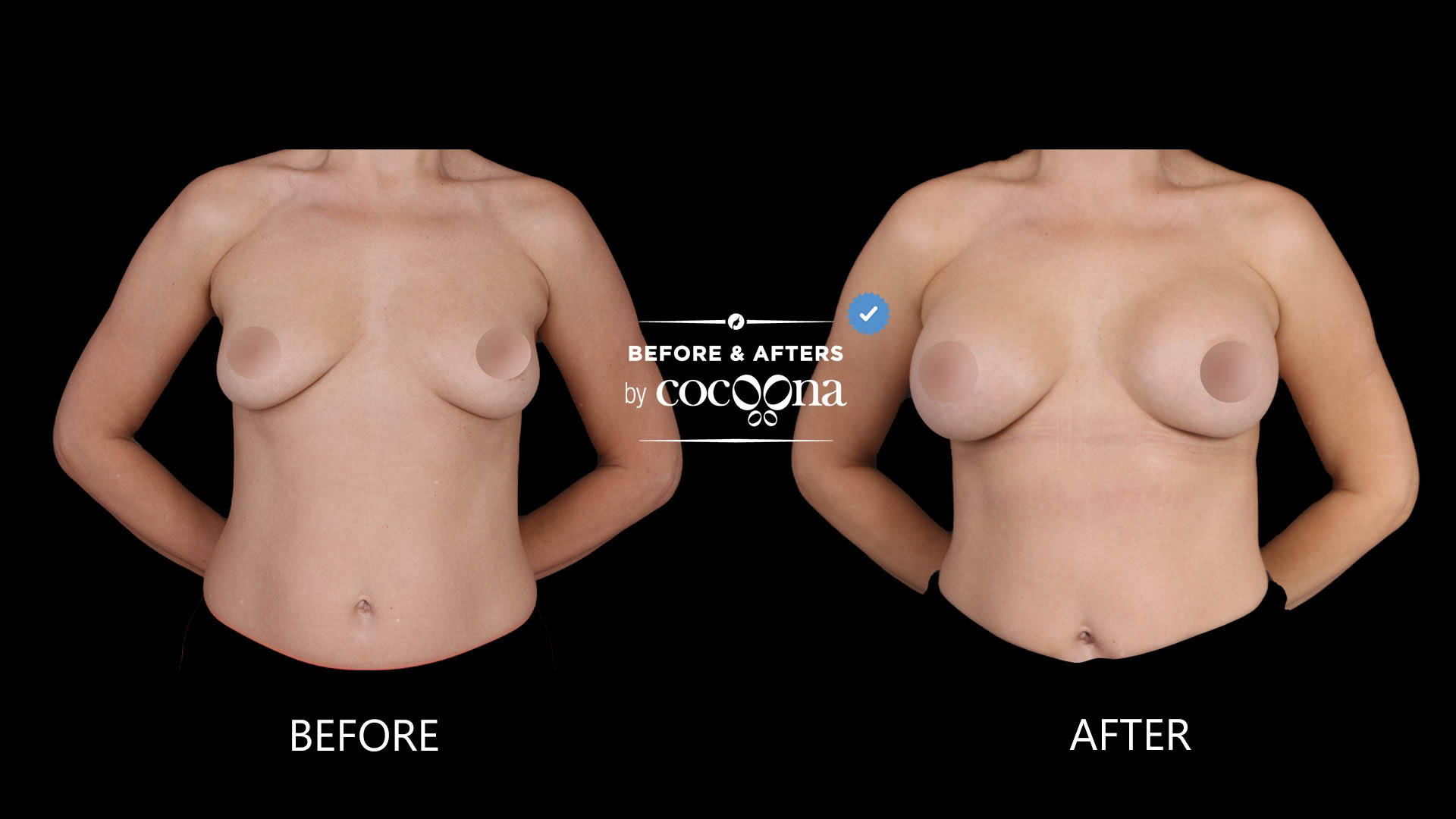 Breast-Augmentation-BA-2