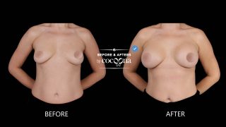 Breast augmentation surgery before and after