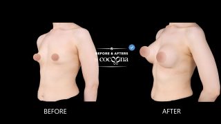 Breast-Augmentation-Before and after