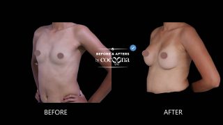 Breast augmentation surgery before and after