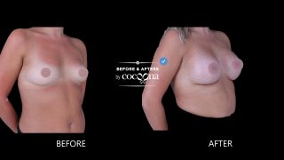 Breast augmentation surgery before and after