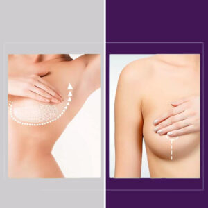 Breast Lift vs. Breast Augmentation