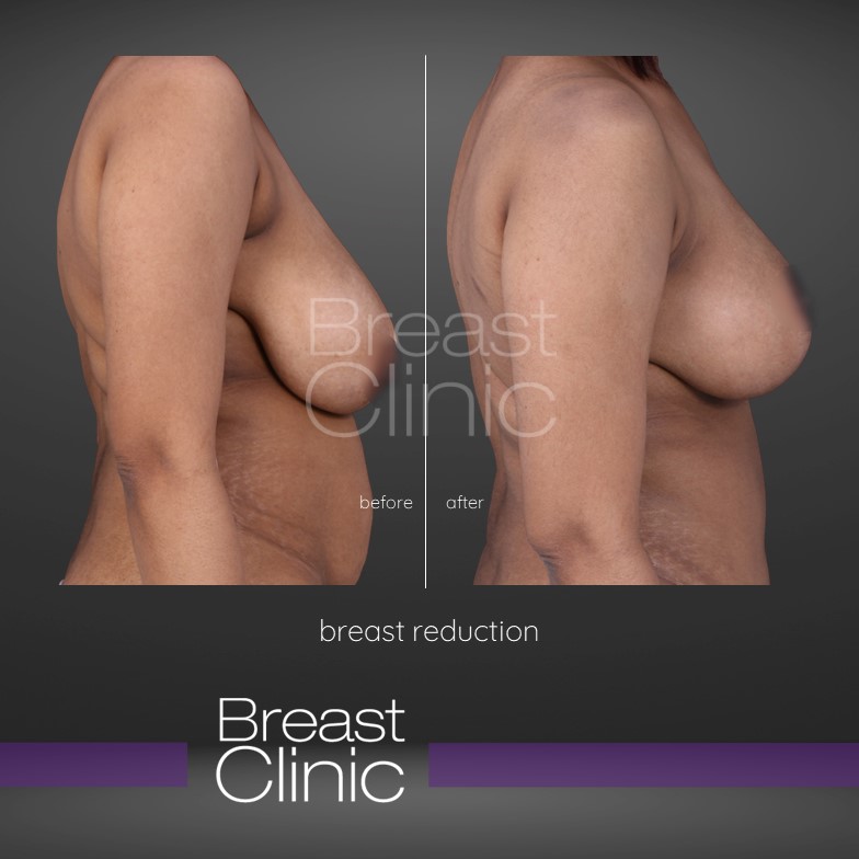 Breast-Reduction-BA-2