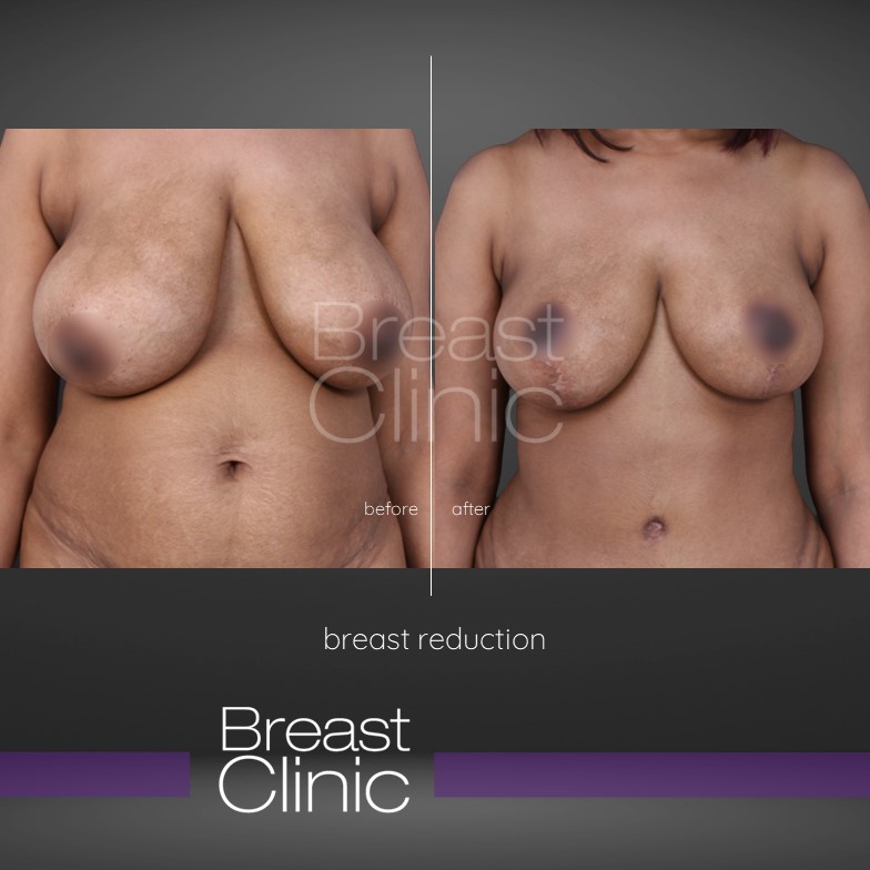 Breast-Reduction-BA-3