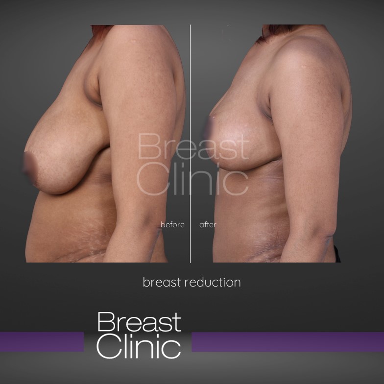 Breast-Reduction-BA