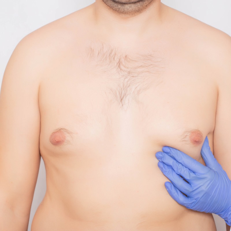 Gynecomastia vs. Chest Fat: Which Do I Have?