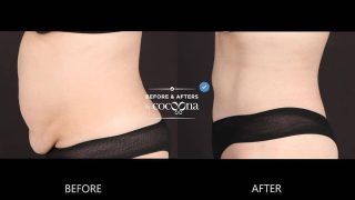 tummy tuck surgery before and after