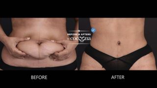 tummy tuck surgery before and after