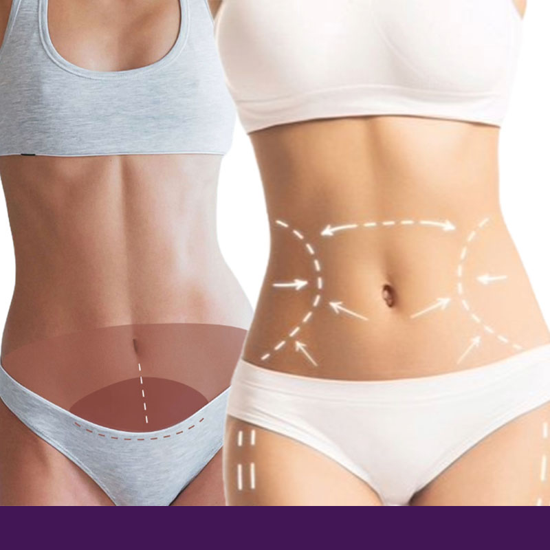 Mini Tummy Tuck vs. Full Tummy Tuck