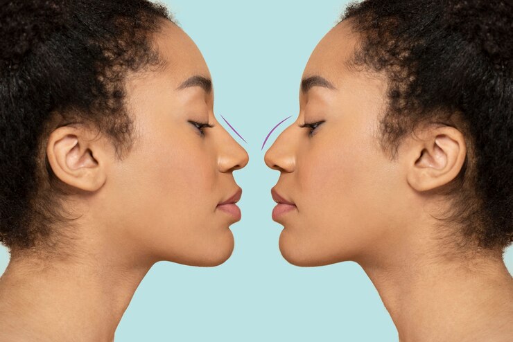 Rhinoplasty