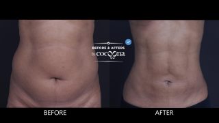 liposuction surgery before and after