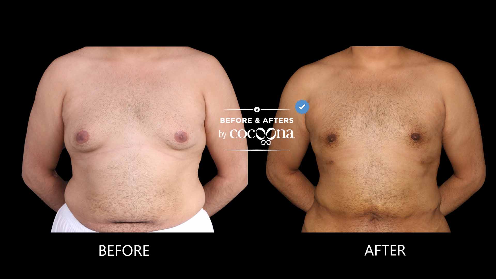 lipo-chest-4-months-post-op-1