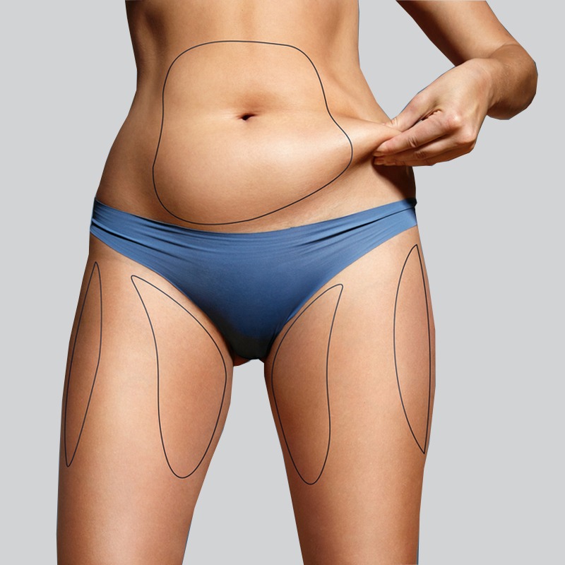 How much weight can you lose with liposuction?