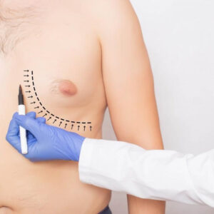 How plastic surgeons help men with gynecomastia?