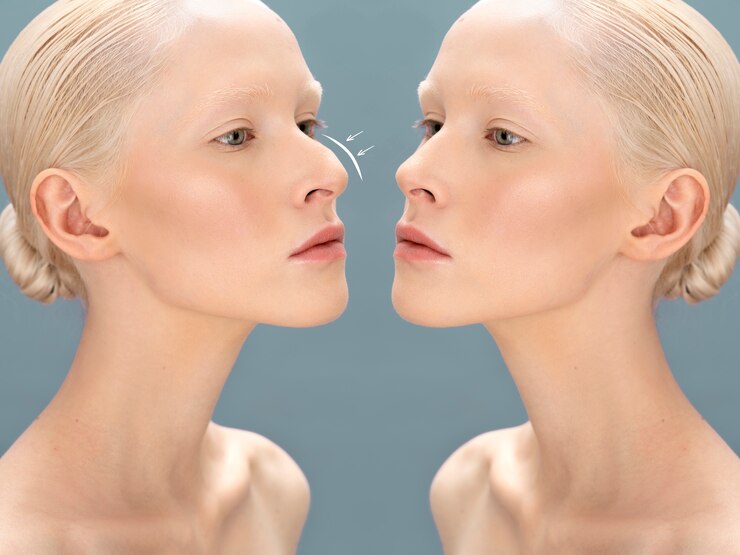 Rhinoplasty Surgery