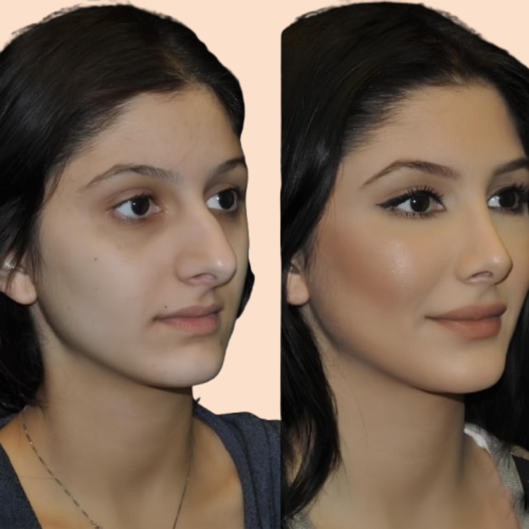 Celebrity Rhinoplasty Surgery: The Procedures Behind the Perfect Nose