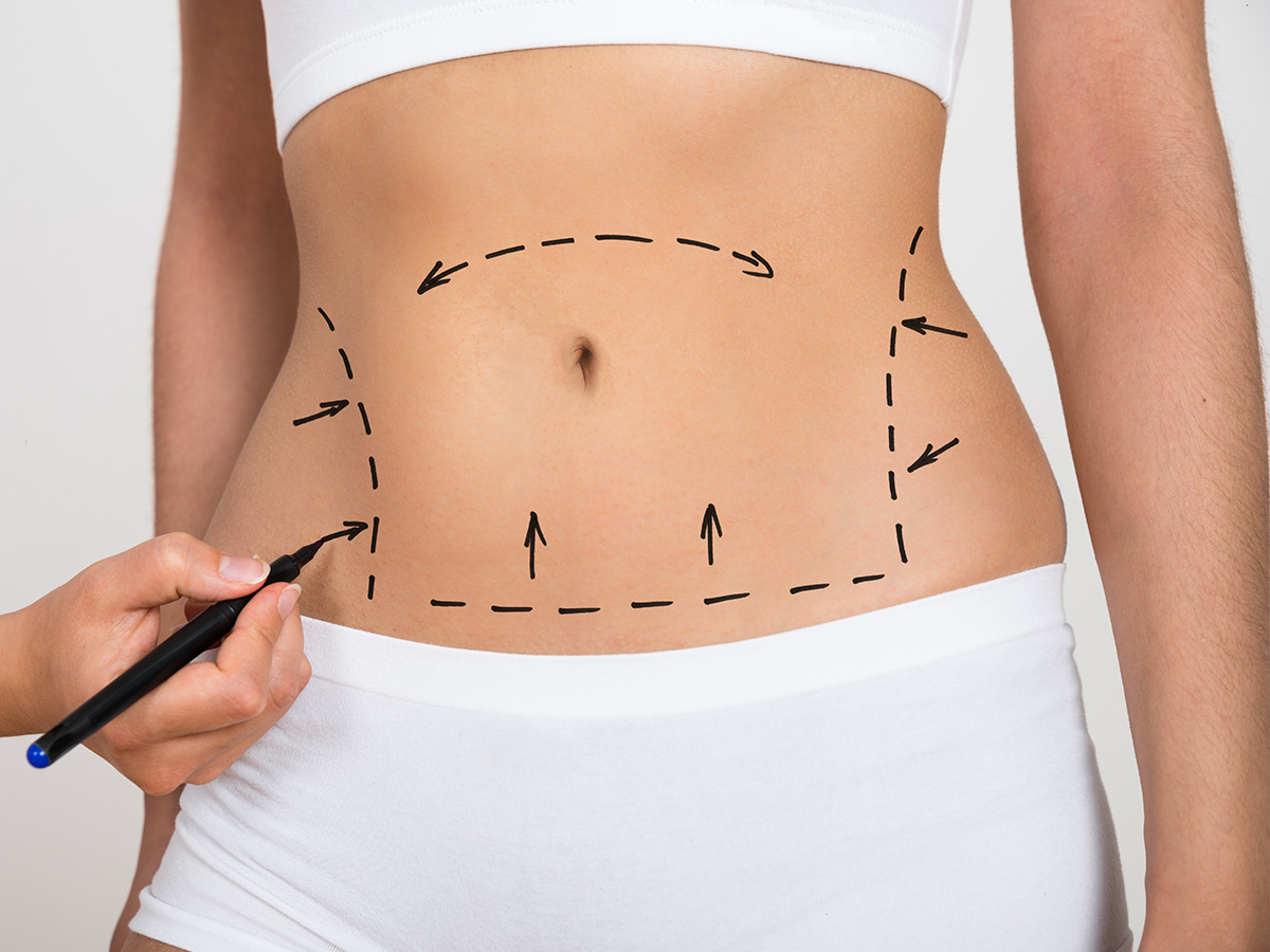 What is the difference between liposuction and tummy tuck surgery?