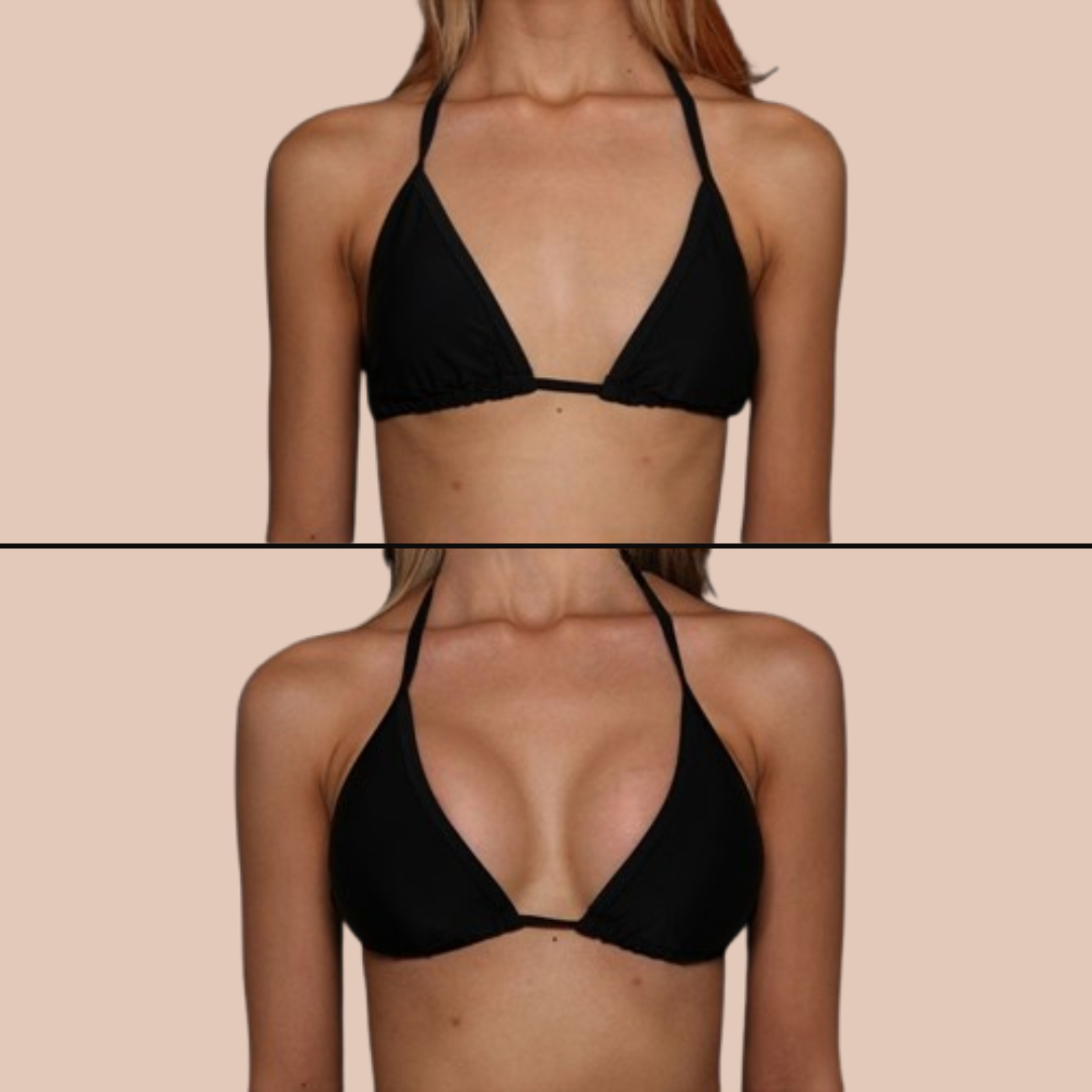 Breast Augmentation vs Breast Lift: What's the Difference?