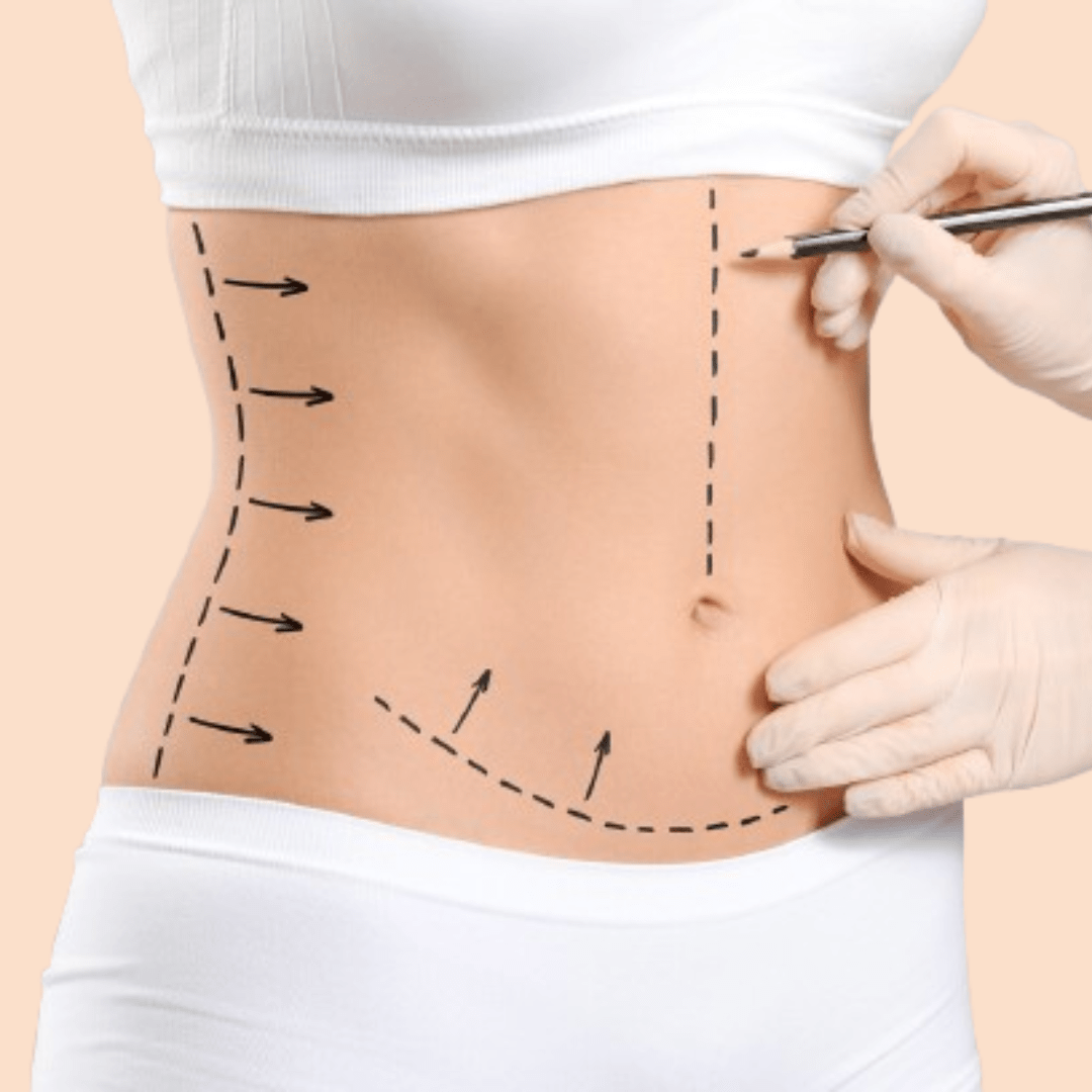 Liposuction Surgery: Who Is the Ideal Candidate?