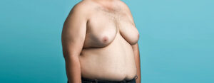 How to Get Rid of Man Breasts