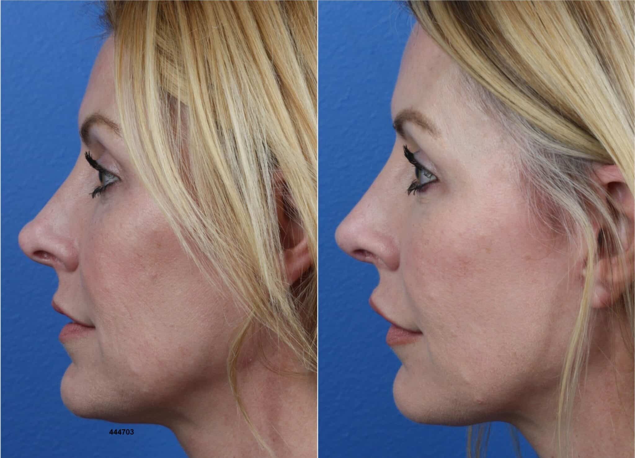 Revision Rhinoplasty