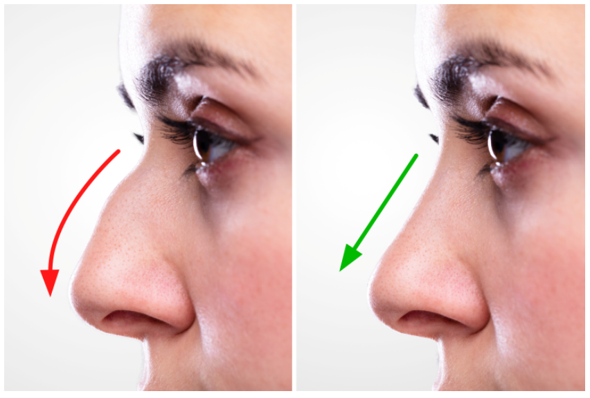 Cosmetic Rhinoplasty