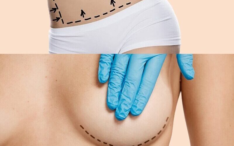 Liposuction Only Reduction