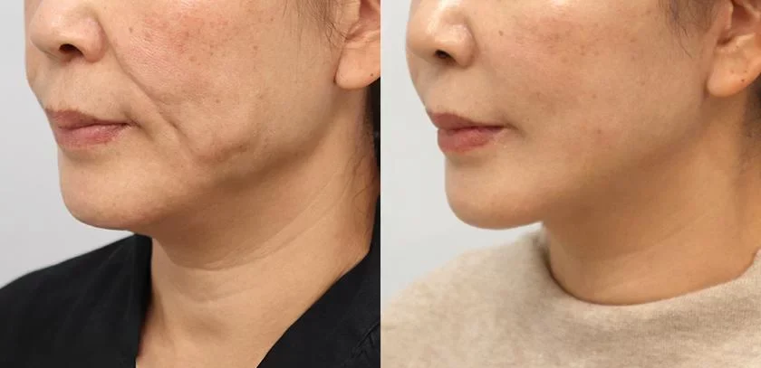 Mini Facelift Gurgaon