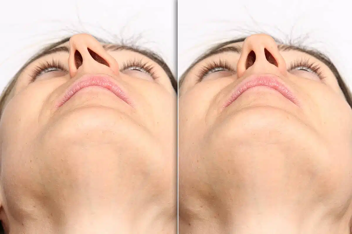 Functional Rhinoplasty and Septoplasty