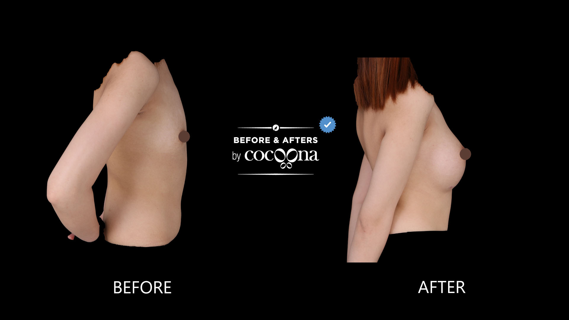 Breast Augmentation BA 3