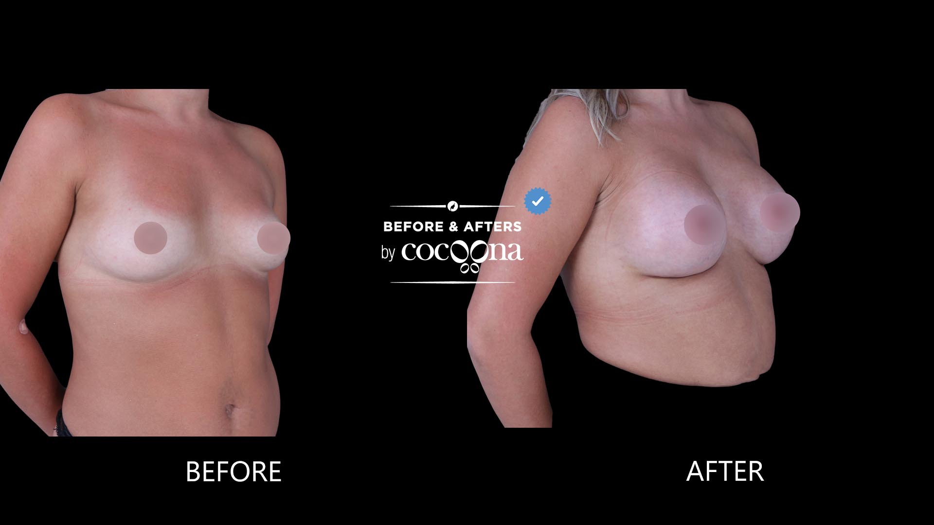 Breast Augmentation BA 5