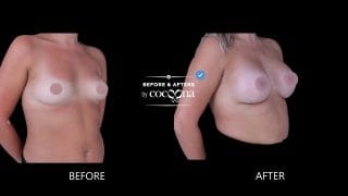 Breast Augmentation BA 5 320x180 1