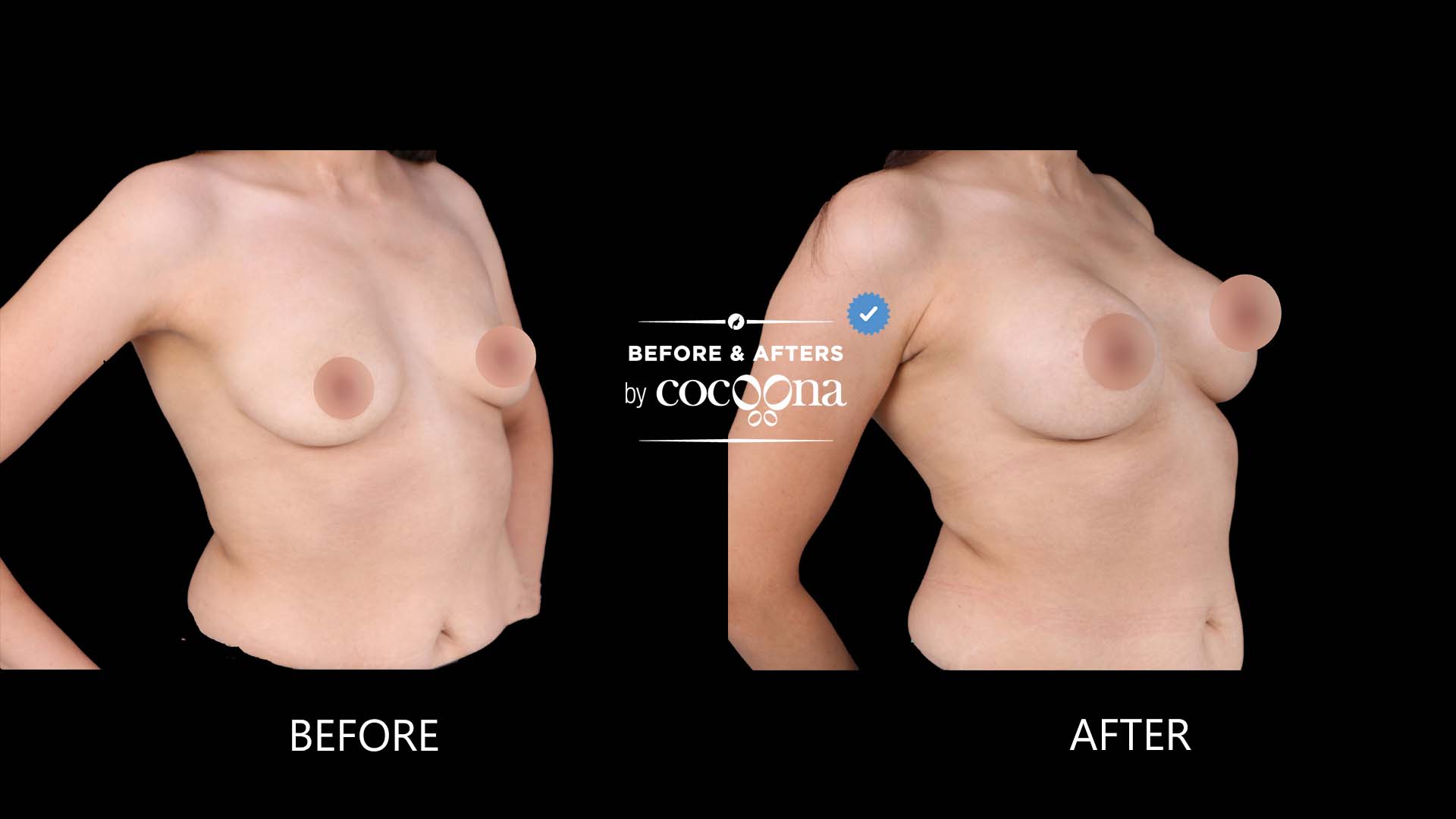Breast Augmentation BA 6