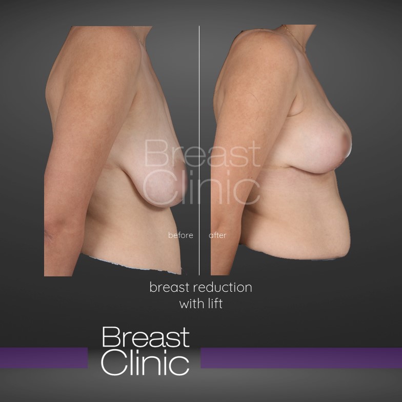 Breast-Reduction-BA-4.jpg