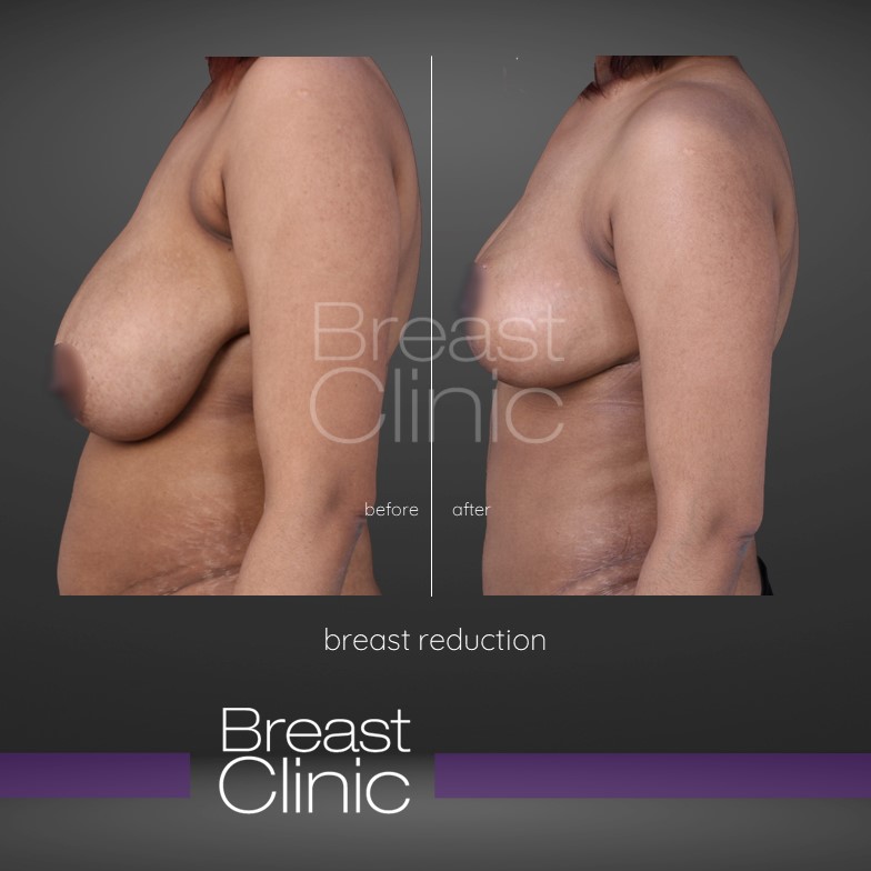 Breast-Reduction-BA.jpg