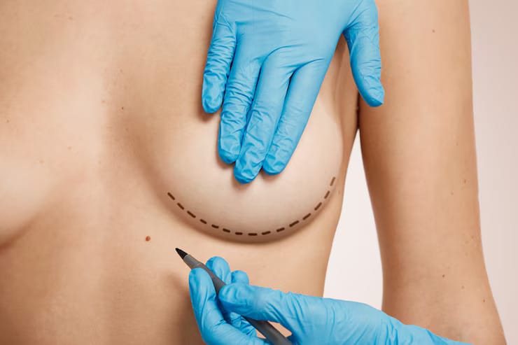 Breast reduction surgery before and after results at Cocoona Clinic