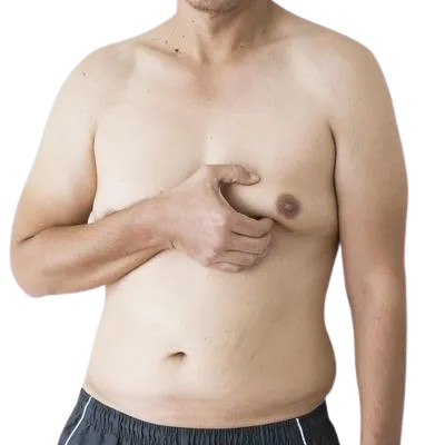 Can You Get Rid of Gynecomastia Without Surgery in Islamabad