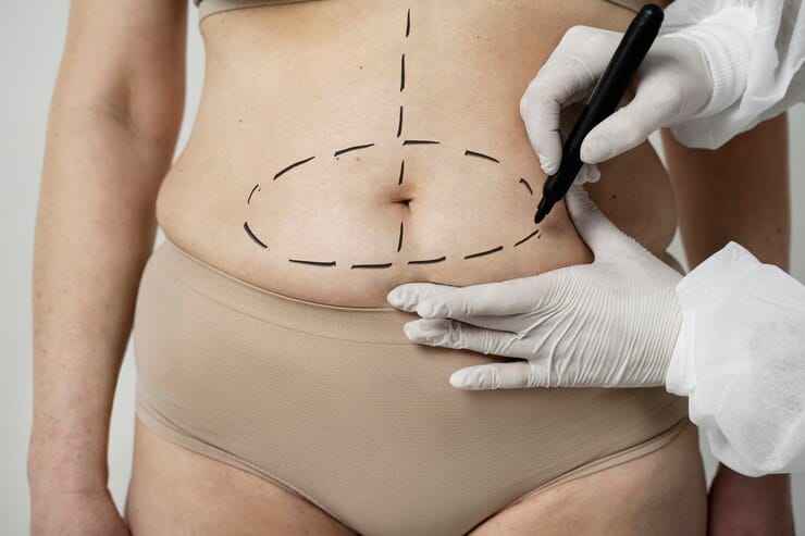 Mommy makeover surgery results at Cocoona Clinic