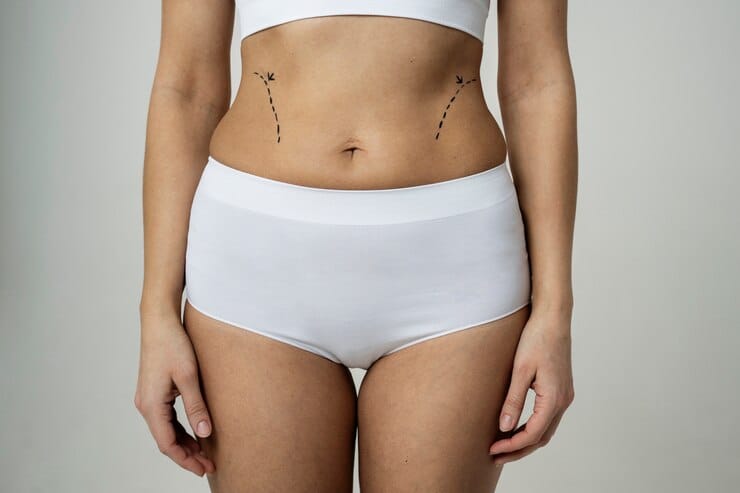 Tummy tuck surgery before and after results at Cocoona Clinic