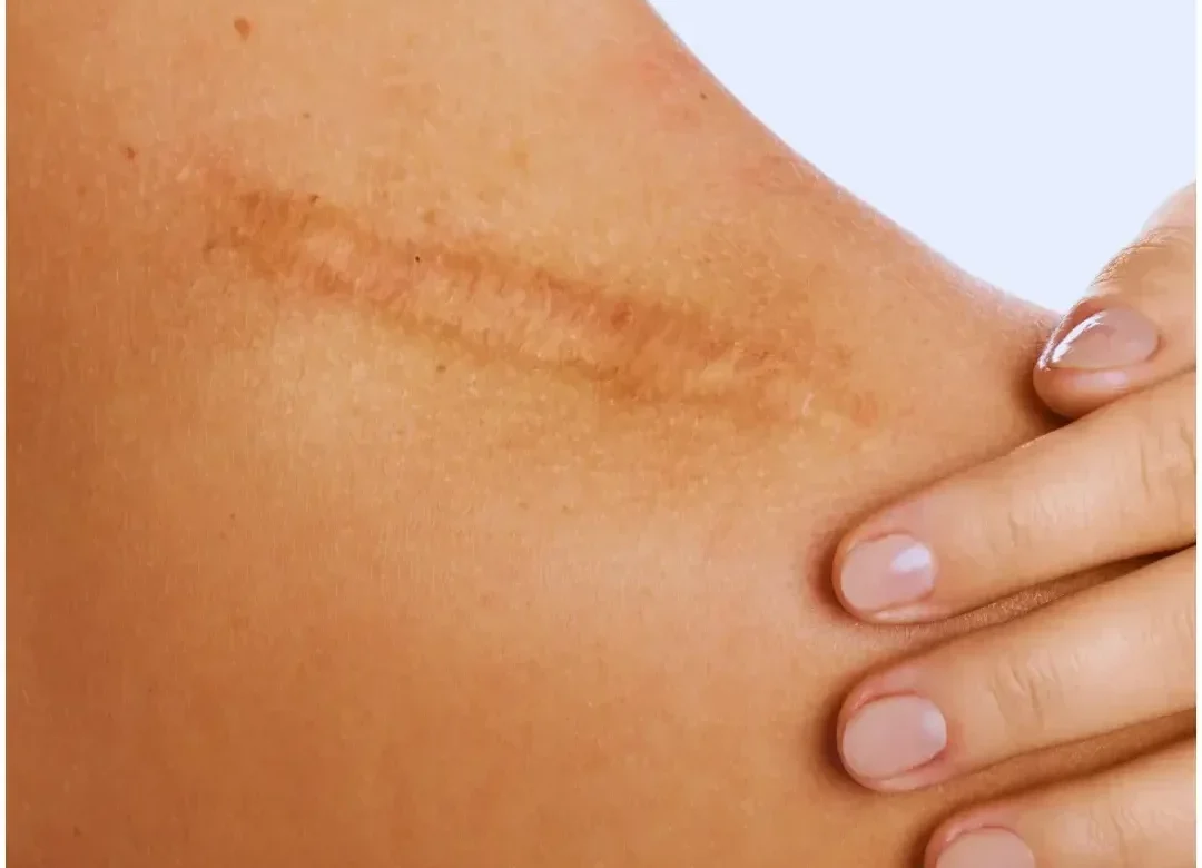Scar revision treatment before and after results