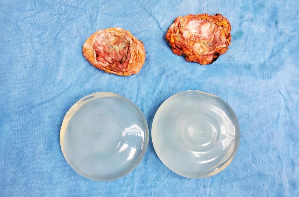 Breast surgery consultation at Cocoona Clinic