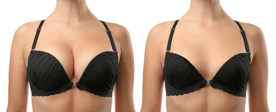 Before and after breast reduction surgery results at Cocoona Clinic