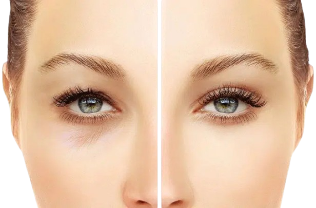 Blepharoplasty 678x446 result