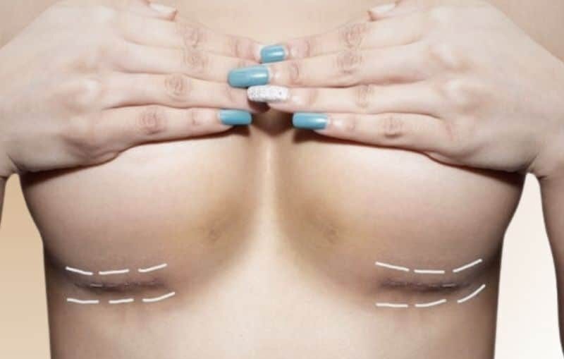 Breast augmentation with fat transfer procedure scars