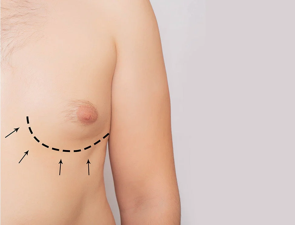 Chest reduction