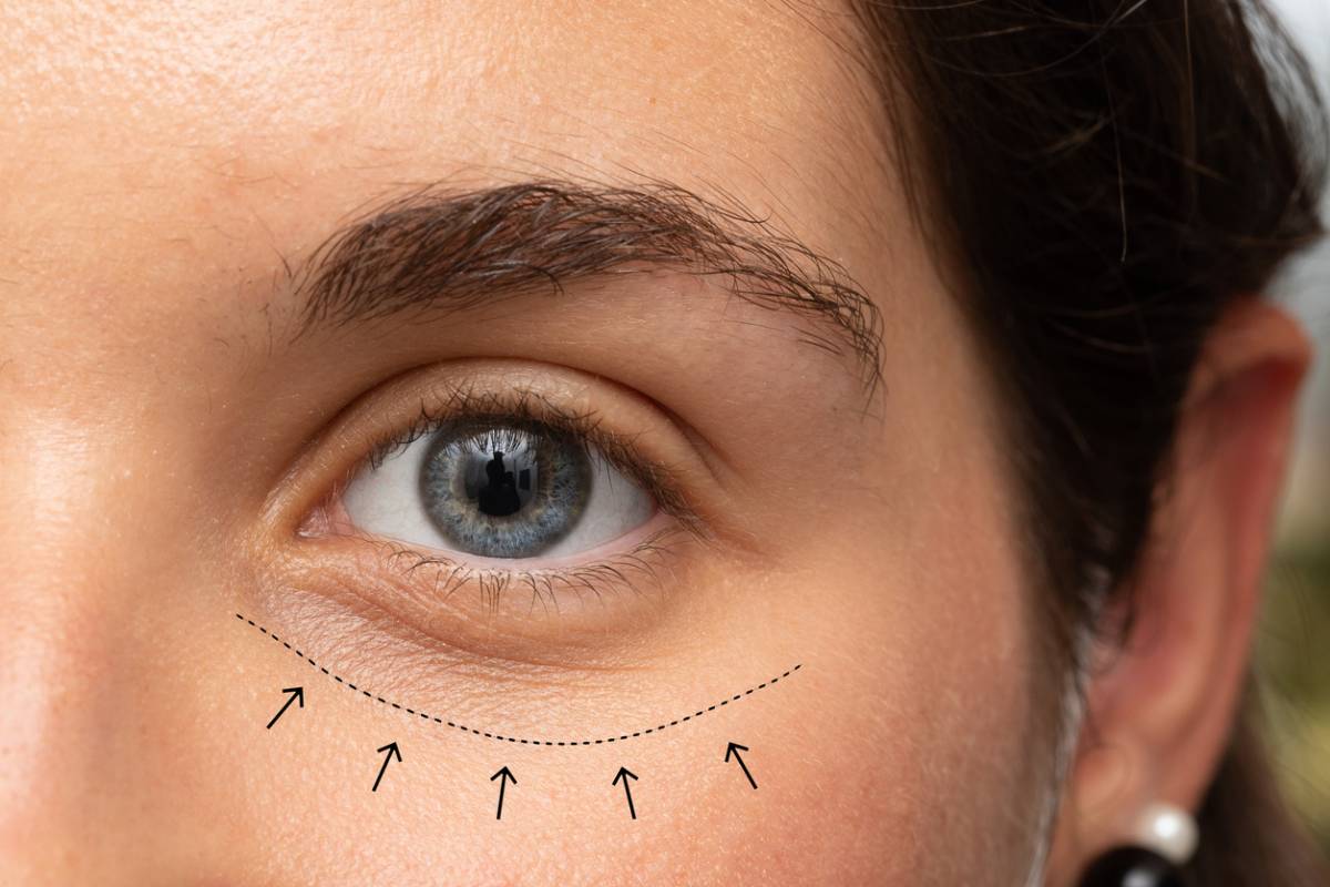 Does revision eyelid surgery cost more