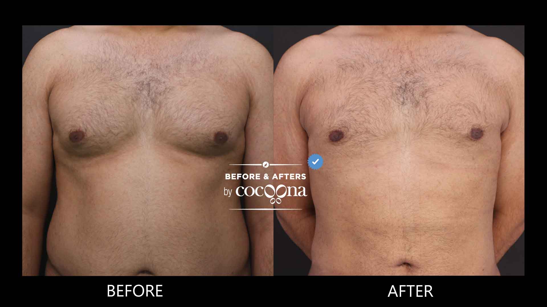 Gynecomastia 1 month and 1 week post op