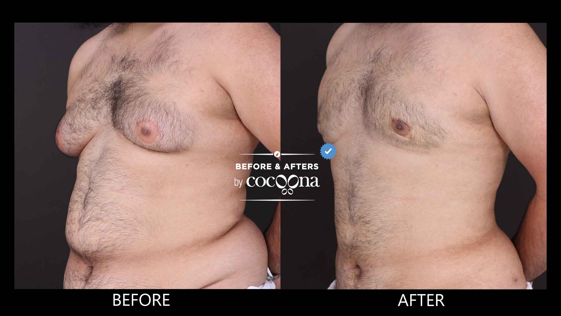 Gynecomastia 1 month post op