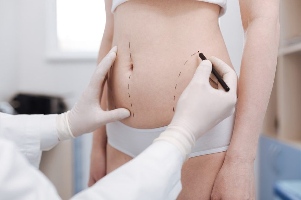 How does liposuction work 1024x683 1