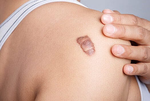 Laser keloid treatment procedure at Cocoona Clinic